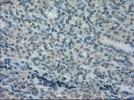 IHC-P analysis of thyroid carcinoma tissue using GTX84617 DHFR antibody [6G7]. Antigen retrieval : Heat-induced epitope retrieval by 10mM citrate buffer, pH6.0, 100oC for 10min. Dilution : 1:50
