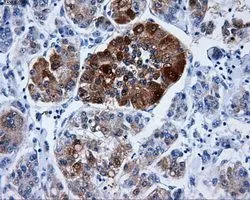 IHC-P analysis of liver carcinoma tissue using GTX84623 DCXR antibody [4D11]. Antigen retrieval : Heat-induced epitope retrieval by 10mM citrate buffer, pH6.0, 100oC for 10min. Dilution : 1:50