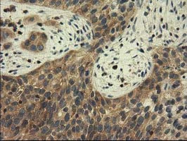 IHC-P analysis of human bladder carcinoma tissue using GTX84728 CBWD1 antibody [4E8].