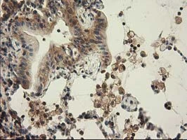 IHC-P analysis of human lung carcinoma tissue using GTX84728 CBWD1 antibody [4E8].