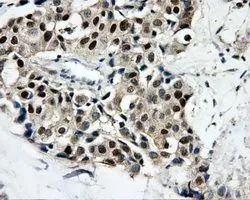 IHC-P analysis of breast adenocarcinoma tissue using GTX84738 CaMKI delta antibody [2C6]. Antigen retrieval : Heat-induced epitope retrieval by 10mM citrate buffer, pH6.0, 100oC for 10min. Dilution : 1:50