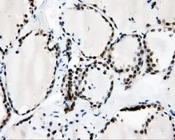 IHC-P analysis of thyroid tissue using GTX84738 CaMKI delta antibody [2C6]. Antigen retrieval : Heat-induced epitope retrieval by 10mM citrate buffer, pH6.0, 100oC for 10min. Dilution : 1:50