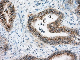 IHC-P analysis of human colon adenocarcinoma tissue using GTX84800 CD147 antibody [7A7]. Antigen retrieval : Heat-induced epitope retrieval by 10mM citrate buffer, pH6.0, 100oC for 10min.