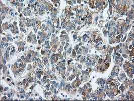 IHC-P analysis of human liver carcinoma tissue using GTX84800 CD147 antibody [7A7]. Antigen retrieval : Heat-induced epitope retrieval by 10mM citrate buffer, pH6.0, 100oC for 10min.