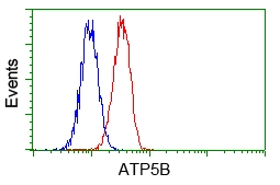 IHC-P analysis of liver carcinoma tissue using GTX84845 ATP5B antibody [1B10]. Antigen retrieval : Heat-induced epitope retrieval by 10mM citrate buffer,pH6.0,100? for 10min. Dilution : 1:50