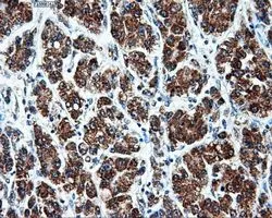 IHC-P analysis of liver carcinoma tissue using GTX84848 ATP5B antibody [6C4]. Antigen retrieval : Heat-induced epitope retrieval by 10mM citrate buffer, pH6.0, 100oC for 10min. Dilution : 1:50