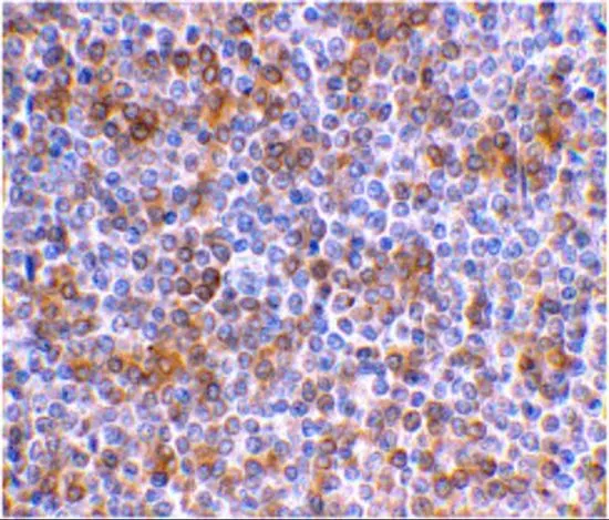 IHC-P analysis of human spleen tissue using GTX85084 APOBEC3G antibody. Working concentration : 1 microg/ml IHC-P analysis of human spleen tissue using GTX85084 APOBEC3G antibody. Working concentration : 1 microg/ml