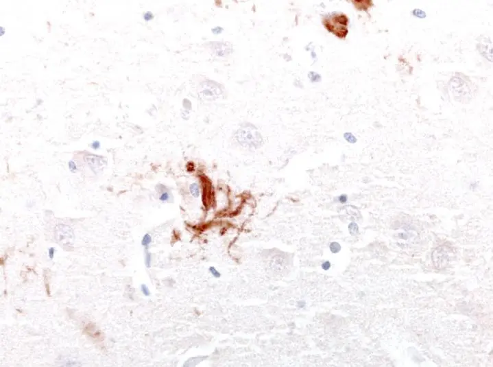 IHC-P analysis of neurofibrillary tangles in cortical neurons of an Alzheimers Disease patient using GTX85468 Tau antibody. Dilution : 1:10,000
