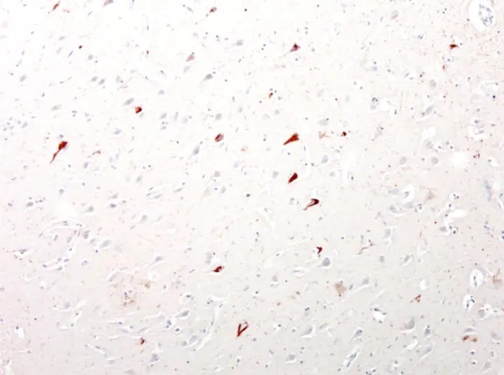 IHC-P analysis of neurofibrillary tangles in cortical neurons of an Alzheimers Disease patient using GTX85468 Tau antibody. Dilution : 1:10,000