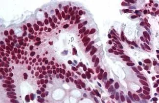 IHC-P analysis of human colon tissue using GTX85787 THRAP3 antibody. Antigen retrieval : Heat-induced antigen retrieval Dilution : 10 microg/ml