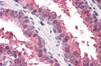 IHC-P analysis of human prostate tissue using GTX85831 RAD23B antibody. Antigen retrieval : Heat-induced antigen retrieval Dilution : 5 microg/ml
