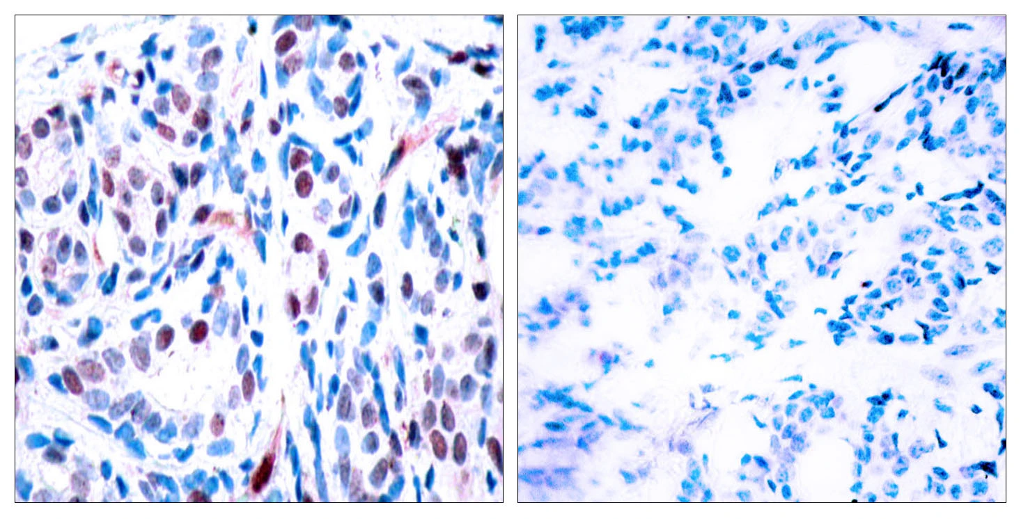 IHC-P analysis of human breast carcinoma tissue using GTX86741 STAT3 (phospho Tyr705) antibody. The picture on the right is blocked with the synthesized peptide. IHC-P analysis of human breast carcinoma tissue using GTX86741 STAT3 (phospho Tyr705) antibody. The picture on the right is blocked with the synthesized peptide.