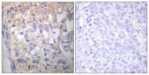 IHC-P analysis of human breast carcinoma using GTX86757 Fyn (phospho Tyr530) antibody. The picture on the right is blocked with the phospho peptide. IHC-P analysis of human breast carcinoma using GTX86757 Fyn (phospho Tyr530) antibody. The picture on the right is blocked with the phospho peptide.