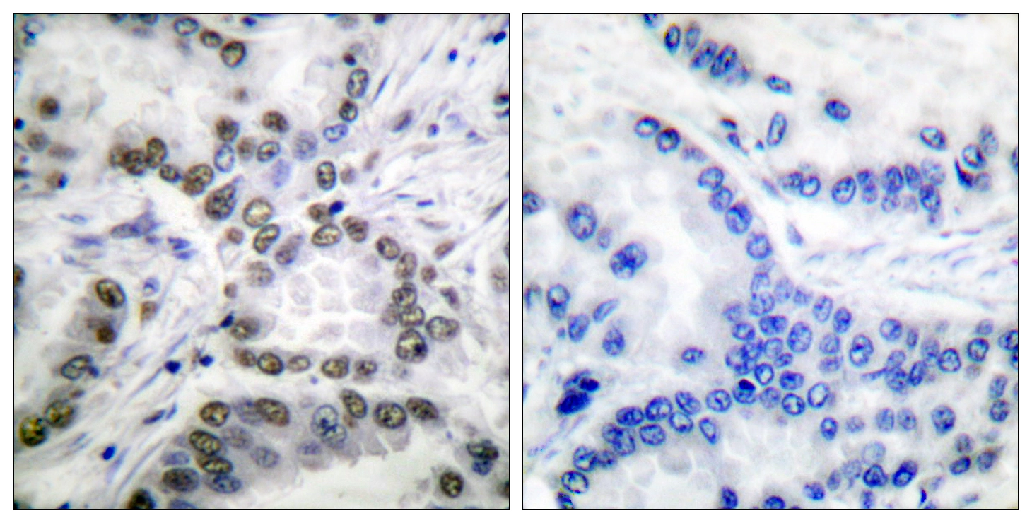 IHC-P analysis of human lung carcinoma tissue using GTX86958 CBP (acetyl Lys1535) antibody. The picture on the right is blocked with the synthesized peptide. IHC-P analysis of human lung carcinoma tissue using GTX86958 CBP (acetyl Lys1535) antibody. The picture on the right is blocked with the synthesized peptide.
