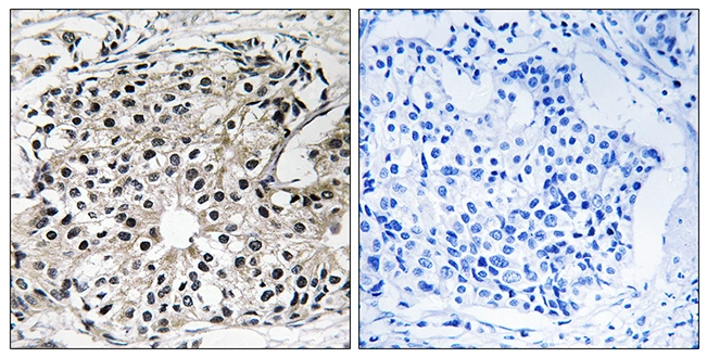 IHC-P analysis of human breast carcinoma tissue using GTX87000 PECI antibody. The picture on the right is blocked with the synthesized peptide. IHC-P analysis of human breast carcinoma tissue using GTX87000 PECI antibody. The picture on the right is blocked with the synthesized peptide.