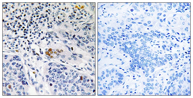 IHC-P analysis of human lung carcinoma tissue using GTX87131 ZBTB40 antibody. The picture on the right is blocked with the synthesized peptide. IHC-P analysis of human lung carcinoma tissue using GTX87131 ZBTB40 antibody. The picture on the right is blocked with the synthesized peptide.