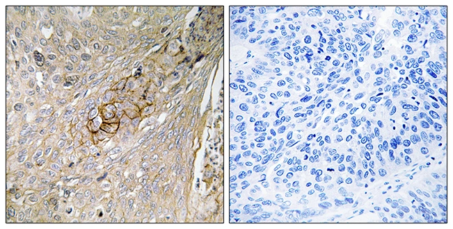 IHC-P analysis of human lung carcinoma tissue using GTX87166 SLC6A6 antibody. The picture on the right is blocked with the synthesized peptide. IHC-P analysis of human lung carcinoma tissue using GTX87166 SLC6A6 antibody. The picture on the right is blocked with the synthesized peptide.