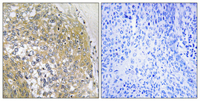 IHC-P analysis of human cervix cancer tissue using GTX87170 S100A16 antibody. The picture on the right is blocked with the synthesized peptide. Dilution: 1:100 Negative control (right) obtained from antibody was pre-absorbed by immunogen peptide.