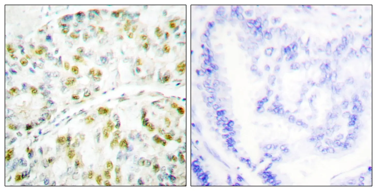 IHC-P analysis of human lung carcinoma tissue using GTX87190 Ataxin 1 antibody. The picture on the right is blocked with the synthesized peptide.