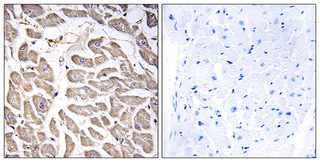 IHC-P analysis of human heart tissue using GTX87222 BRWD3 antibody. The picture on the right is blocked with the synthesized peptide. IHC-P analysis of human heart tissue using GTX87222 BRWD3 antibody. The picture on the right is blocked with the synthesized peptide.