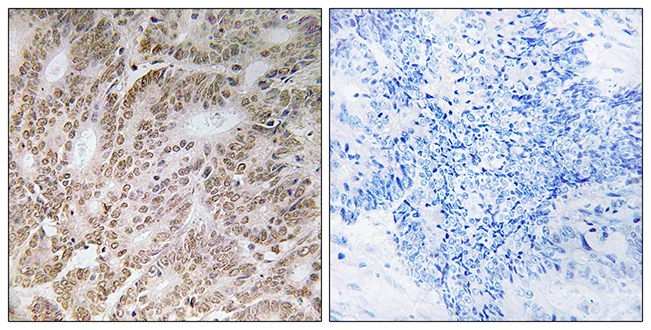 IHC-P analysis of human colon carcinoma tissue using GTX87325 Ubiquilin 4 antibody. The picture on the right is blocked with the synthesized peptide. IHC-P analysis of human colon carcinoma tissue using GTX87325 Ubiquilin 4 antibody. The picture on the right is blocked with the synthesized peptide.