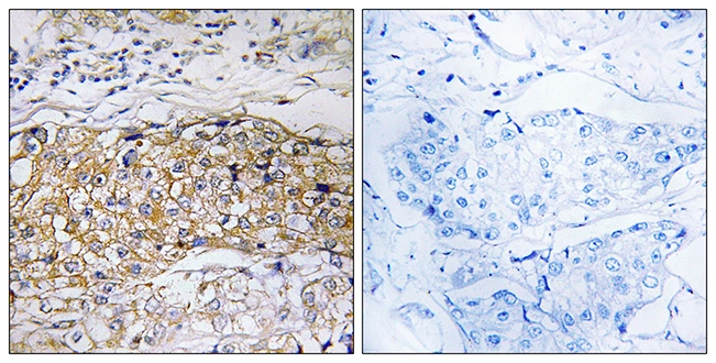 IHC-P analysis of human breast carcinoma tissue using GTX87342 USP24 antibody. The picture on the right is blocked with the synthesized peptide. IHC-P analysis of human breast carcinoma tissue using GTX87342 USP24 antibody. The picture on the right is blocked with the synthesized peptide.