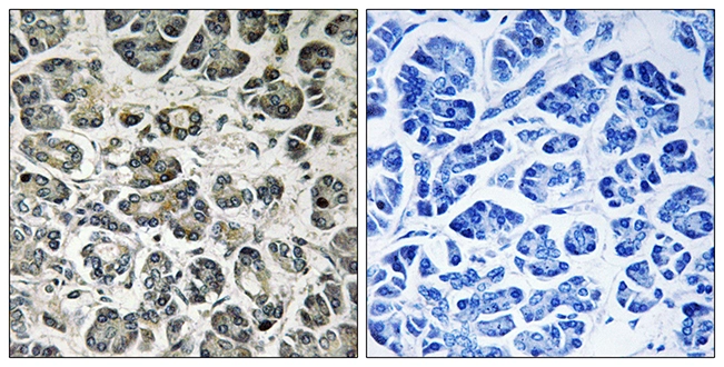 IHC-P analysis of human pancreas tissue using GTX87418 NDUFA8 antibody. The picture on the right is blocked with the synthesized peptide. IHC-P analysis of human pancreas tissue using GTX87418 NDUFA8 antibody. The picture on the right is blocked with the synthesized peptide.