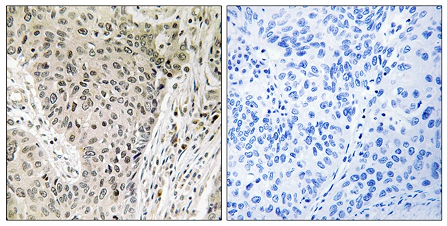 IHC-P analysis of human lung carcinoma tissue using GTX87469 ARHGEF19 antibody. The picture on the right is blocked with the synthesized peptide. IHC-P analysis of human lung carcinoma tissue using GTX87469 ARHGEF19 antibody. The picture on the right is blocked with the synthesized peptide.