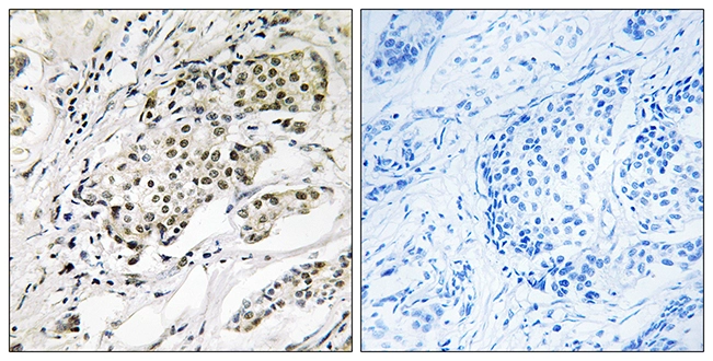 IHC-P analysis of human breast carcinoma tissue using GTX87476 CDYL2 antibody. The picture on the right is blocked with the synthesized peptide. IHC-P analysis of human breast carcinoma tissue using GTX87476 CDYL2 antibody. The picture on the right is blocked with the synthesized peptide.