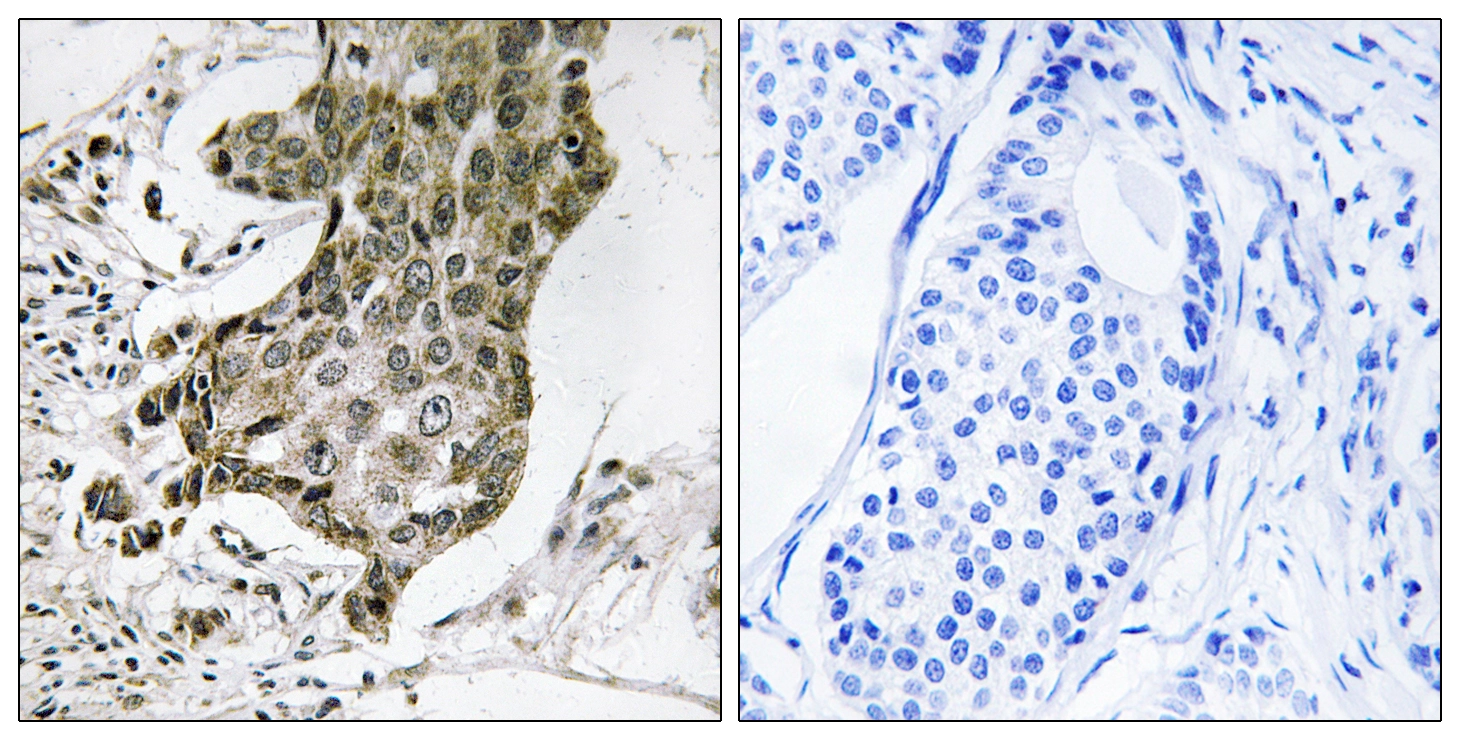 IHC-P analysis of human breast carcinoma tissue using GTX87480 RABEP1 antibody. The picture on the right is blocked with the synthesized peptide. IHC-P analysis of human breast carcinoma tissue using GTX87480 RABEP1 antibody. The picture on the right is blocked with the synthesized peptide.