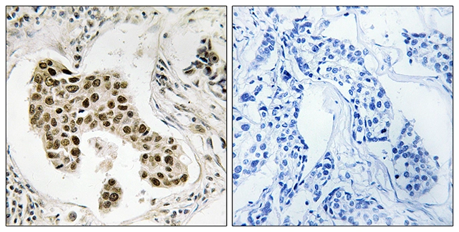 IHC-P analysis of human breast carcinoma tissue using GTX87509 PMS2/PMS2CL antibody. The picture on the right is blocked with the synthesized peptide. IHC-P analysis of human breast carcinoma tissue using GTX87509 PMS2/PMS2CL antibody. The picture on the right is blocked with the synthesized peptide.