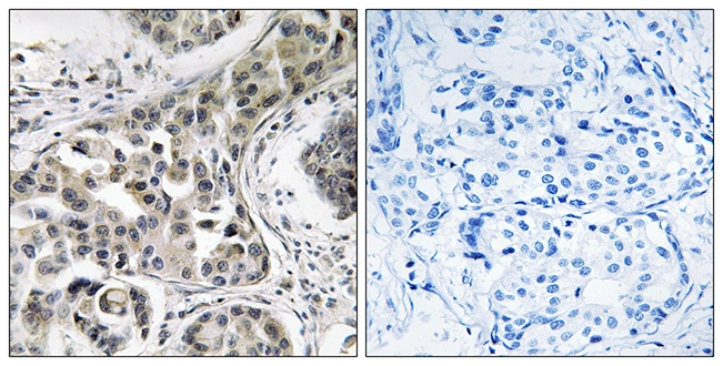 IHC-P analysis of human breast carcinoma tissue using GTX87538 USP6NL antibody. The picture on the right is blocked with the synthesized peptide. IHC-P analysis of human breast carcinoma tissue using GTX87538 USP6NL antibody. The picture on the right is blocked with the synthesized peptide.