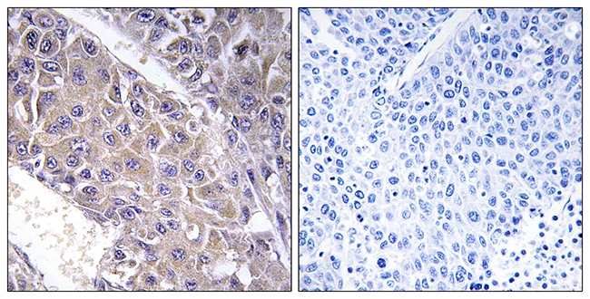 IHC-P analysis of human liver carcinoma tissue using GTX87547 B4GALT3 antibody. The picture on the right is blocked with the synthesized peptide. IHC-P analysis of human liver carcinoma tissue using GTX87547 B4GALT3 antibody. The picture on the right is blocked with the synthesized peptide.