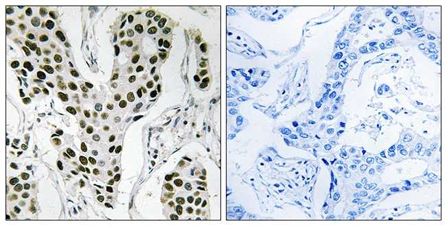 IHC-P analysis of human breast carcinoma tissue using GTX87548 ZC3H4 antibody. The picture on the right is blocked with the synthesized peptide. IHC-P analysis of human breast carcinoma tissue using GTX87548 ZC3H4 antibody. The picture on the right is blocked with the synthesized peptide.