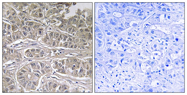 IHC-P analysis of human liver carcinoma tissue using GTX87583 SLC25A21 antibody. The picture on the right is blocked with the synthesized peptide. IHC-P analysis of human liver carcinoma tissue using GTX87583 SLC25A21 antibody. The picture on the right is blocked with the synthesized peptide.