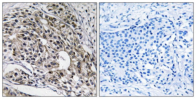 IHC-P analysis of human breast carcinoma tissue using GTX87614 MRPL13 antibody. The picture on the right is blocked with the synthesized peptide. IHC-P analysis of human breast carcinoma tissue using GTX87614 MRPL13 antibody. The picture on the right is blocked with the synthesized peptide.