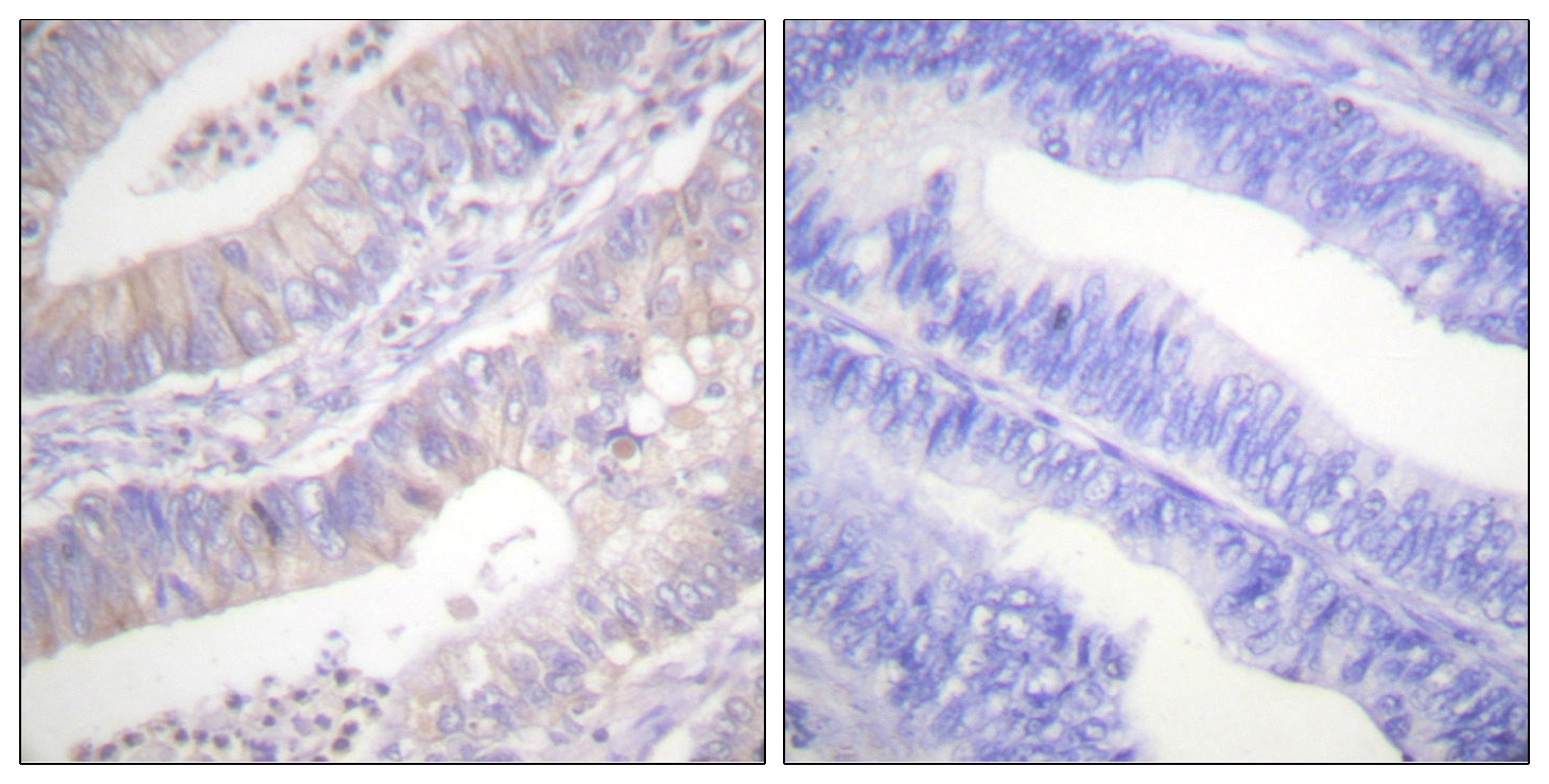 IHC-P analysis of human colon carcinoma tissue using GTX87672 CFTR antibody. The picture on the right is blocked with the synthesized peptide. IHC-P analysis of human colon carcinoma tissue using GTX87672 CFTR antibody. The picture on the right is blocked with the synthesized peptide.