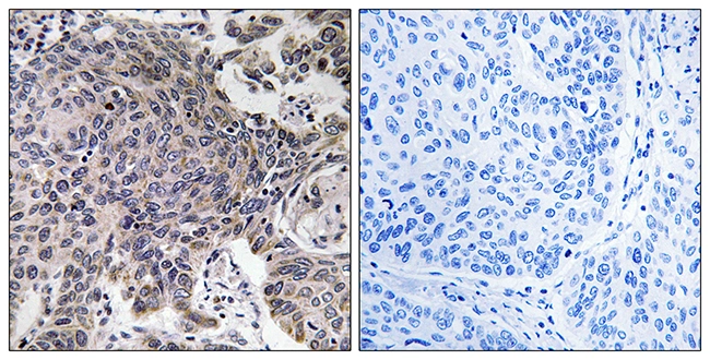 IHC-P analysis of human lung carcinoma tissue using GTX87675 MRPL54 antibody. The picture on the right is blocked with the synthesized peptide. IHC-P analysis of human lung carcinoma tissue using GTX87675 MRPL54 antibody. The picture on the right is blocked with the synthesized peptide.