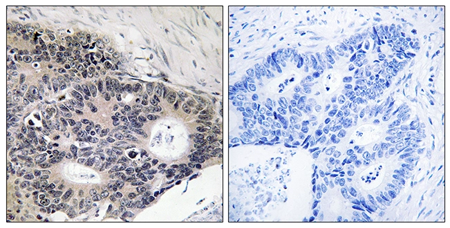 IHC-P analysis of human colon carcinoma tissue using GTX87709 ABHD12B antibody. The picture on the right is blocked with the synthesized peptide. IHC-P analysis of human colon carcinoma tissue using GTX87709 ABHD12B antibody. The picture on the right is blocked with the synthesized peptide.