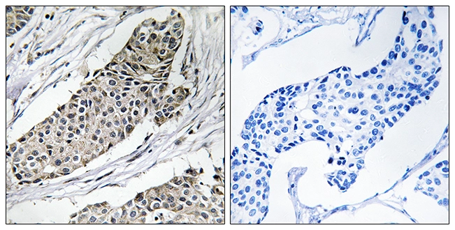 IHC-P analysis of human breast carcinoma tissue using GTX87771 KCNAB3 antibody. The picture on the right is blocked with the synthesized peptide. IHC-P analysis of human breast carcinoma tissue using GTX87771 KCNAB3 antibody. The picture on the right is blocked with the synthesized peptide.