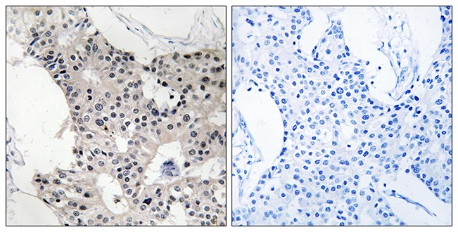 IHC-P analysis of human breast carcinoma tissue using GTX87778 BAGE4 antibody. The picture on the right is blocked with the synthesized peptide. IHC-P analysis of human breast carcinoma tissue using GTX87778 BAGE4 antibody. The picture on the right is blocked with the synthesized peptide.