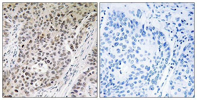 IHC-P analysis of human lung carcinoma tissue using GTX87788 ZNF608 antibody. The picture on the right is blocked with the synthesized peptide. IHC-P analysis of human lung carcinoma tissue using GTX87788 ZNF608 antibody. The picture on the right is blocked with the synthesized peptide.