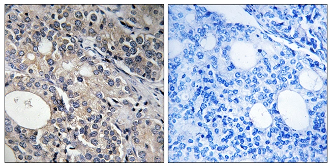 IHC-P analysis of human prostate carcinoma tissue using GTX87817 RPL17 antibody. The picture on the right is blocked with the synthesized peptide. IHC-P analysis of human prostate carcinoma tissue using GTX87817 RPL17 antibody. The picture on the right is blocked with the synthesized peptide.