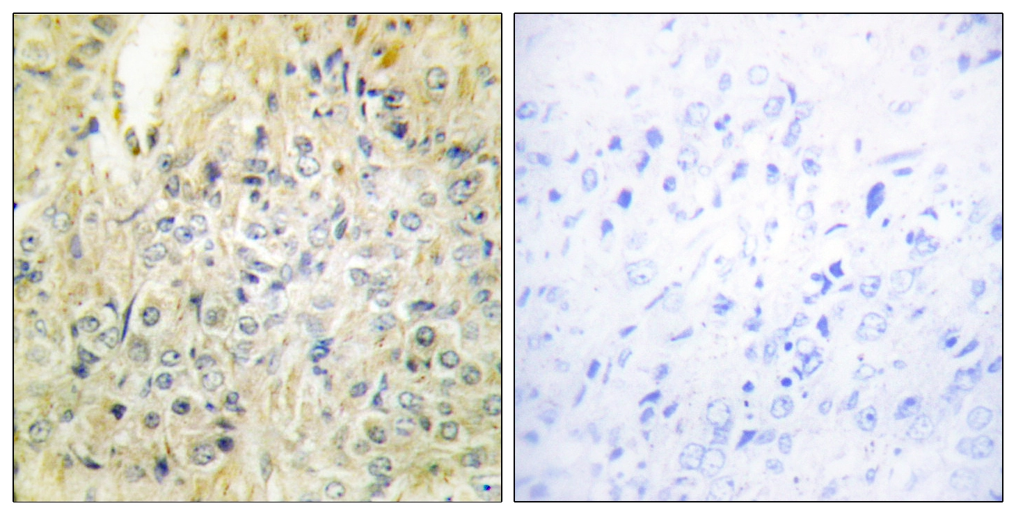 IHC-P analysis of human prostate carcinoma tissue using GTX87820 DLEC1 antibody. The picture on the right is blocked with the synthesized peptide.
