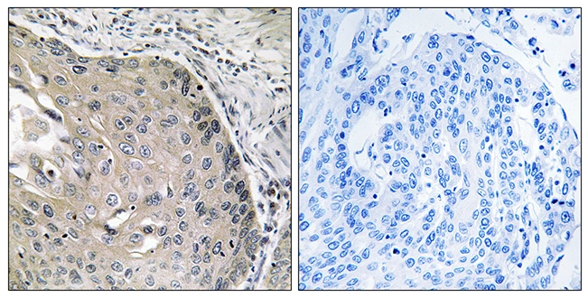 IHC-P analysis of human lung carcinoma tissue using GTX87822 AOX1 antibody. The picture on the right is blocked with the synthesized peptide. IHC-P analysis of human lung carcinoma tissue using GTX87822 AOX1 antibody. The picture on the right is blocked with the synthesized peptide.
