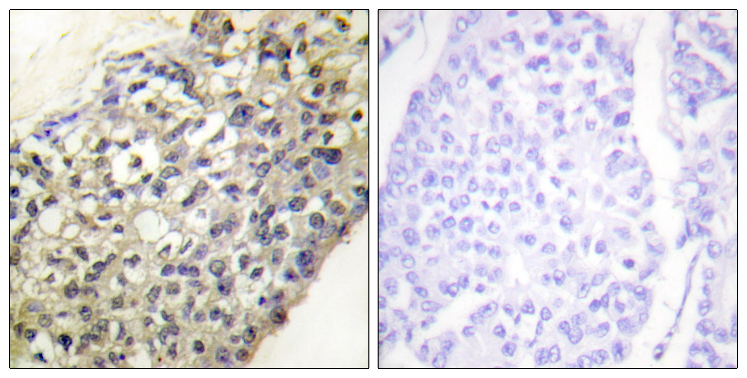 IHC-P analysis of human breast carcinoma tissue using GTX87824 LATH antibody. The picture on the right is blocked with the synthesized peptide.