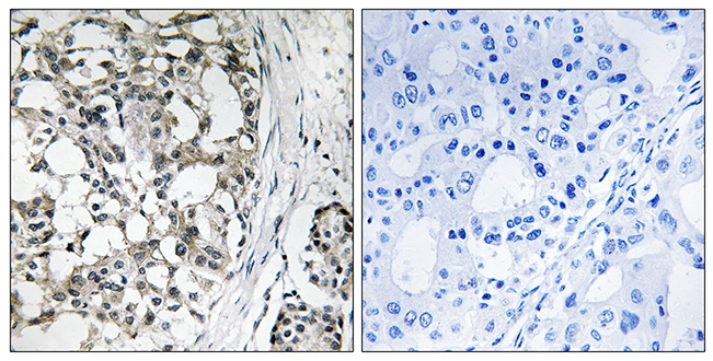 IHC-P analysis of human breast carcinoma tissue using GTX87875 PEX14 antibody. The picture on the right is blocked with the synthesized peptide. IHC-P analysis of human breast carcinoma tissue using GTX87875 PEX14 antibody. The picture on the right is blocked with the synthesized peptide.