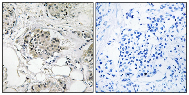 IHC-P analysis of human breast carcinoma tissue using GTX87905 USP13 antibody. The picture on the right is blocked with the synthesized peptide. IHC-P analysis of human breast carcinoma tissue using GTX87905 USP13 antibody. The picture on the right is blocked with the synthesized peptide.