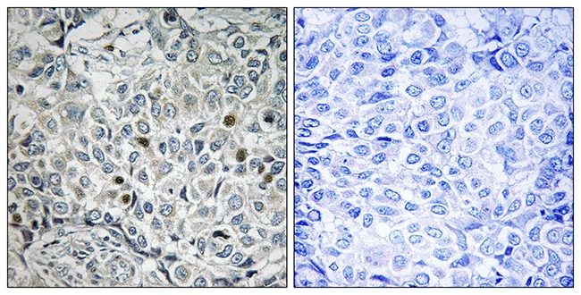 IHC-P analysis of human breast carcinoma tissue using GTX87956 USP53 antibody. The picture on the right is blocked with the synthesized peptide. IHC-P analysis of human breast carcinoma tissue using GTX87956 USP53 antibody. The picture on the right is blocked with the synthesized peptide.
