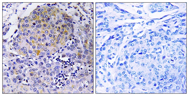 IHC-P analysis of human breast carcinoma tissue using GTX87967 CEP78 antibody. The picture on the right is blocked with the synthesized peptide. IHC-P analysis of human breast carcinoma tissue using GTX87967 CEP78 antibody. The picture on the right is blocked with the synthesized peptide.